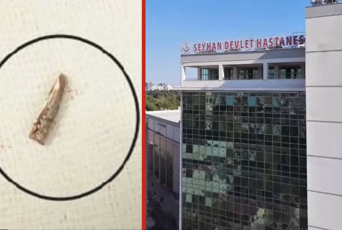 Hastada Unutuldu, Ameliyatla Çıkartıldı 